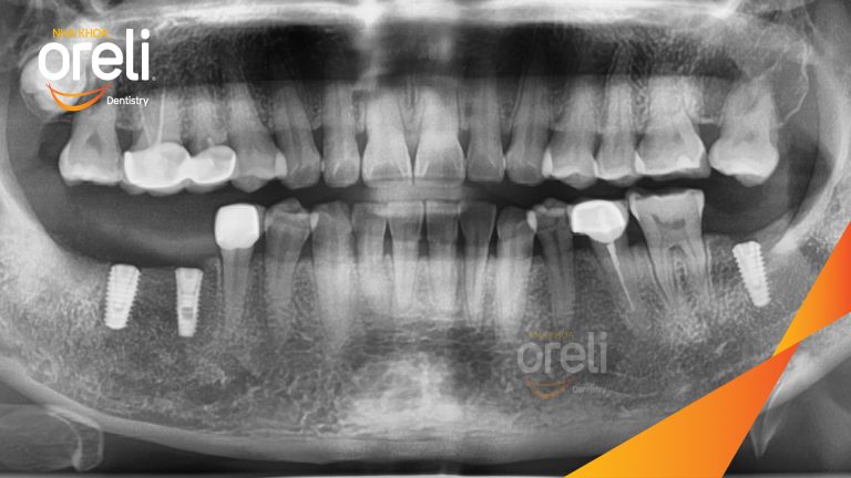 Ca Cấy Ghép Implant Hàm Dưới – Case thực tế tại Oreli