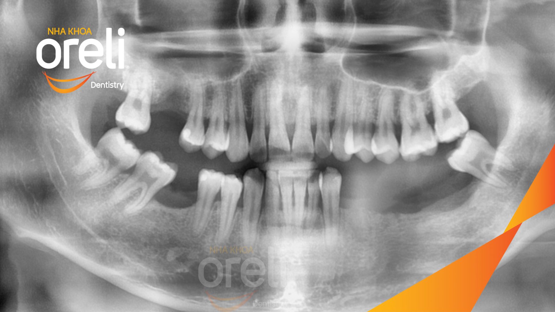Trước điều trị: Mất răng hàm trên và dưới tại Oreli
