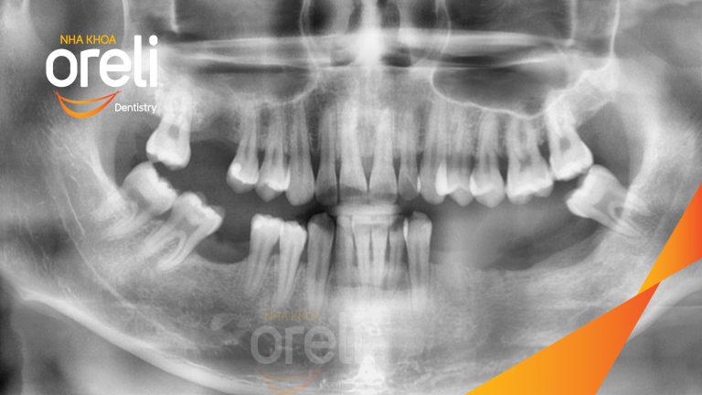 Ca Cấy Ghép Implant Phục Hồi Răng Tại Nha Khoa Oreli