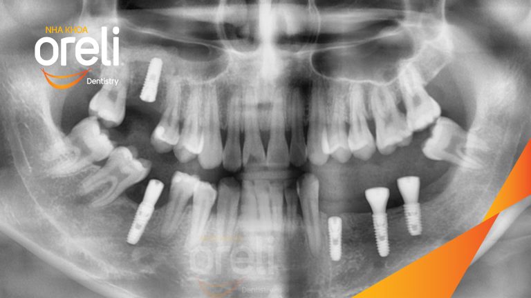 Ca Cấy Ghép Implant Phục Hồi Răng Tại Nha Khoa Oreli