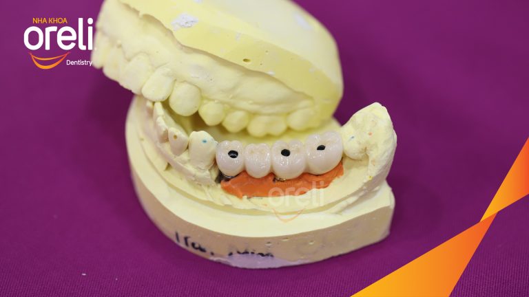 Ca Cấy Ghép Implant Phục Hồi Răng Tại Nha Khoa Oreli