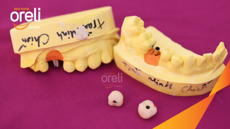 Ca Cấy Ghép Implant Phục Hồi Răng Tại Nha Khoa Oreli
