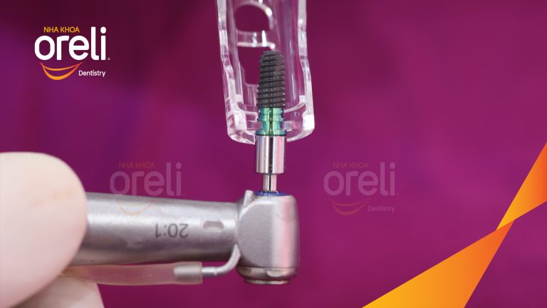 Ca Cấy Ghép Implant Phục Hồi Răng Tại Nha Khoa Oreli