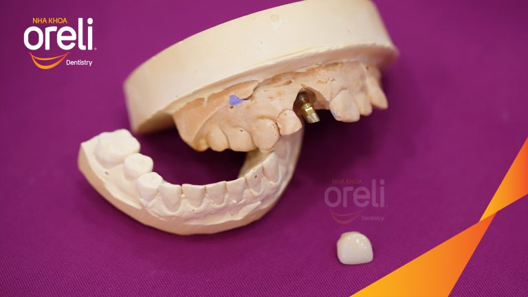Cấy Ghép Implant Phục Hồi Răng Tại Nha Khoa Oreli