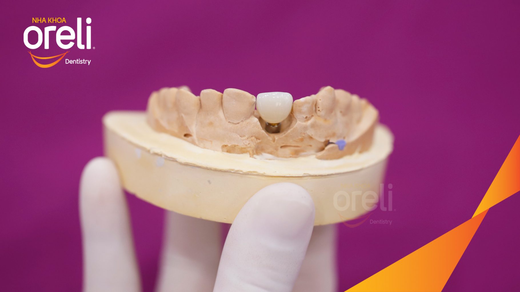 Thực hiện Cấy ghép trụ Implant chính hãng vào vùng mất răng kéo dài 3 tháng tại Oreli