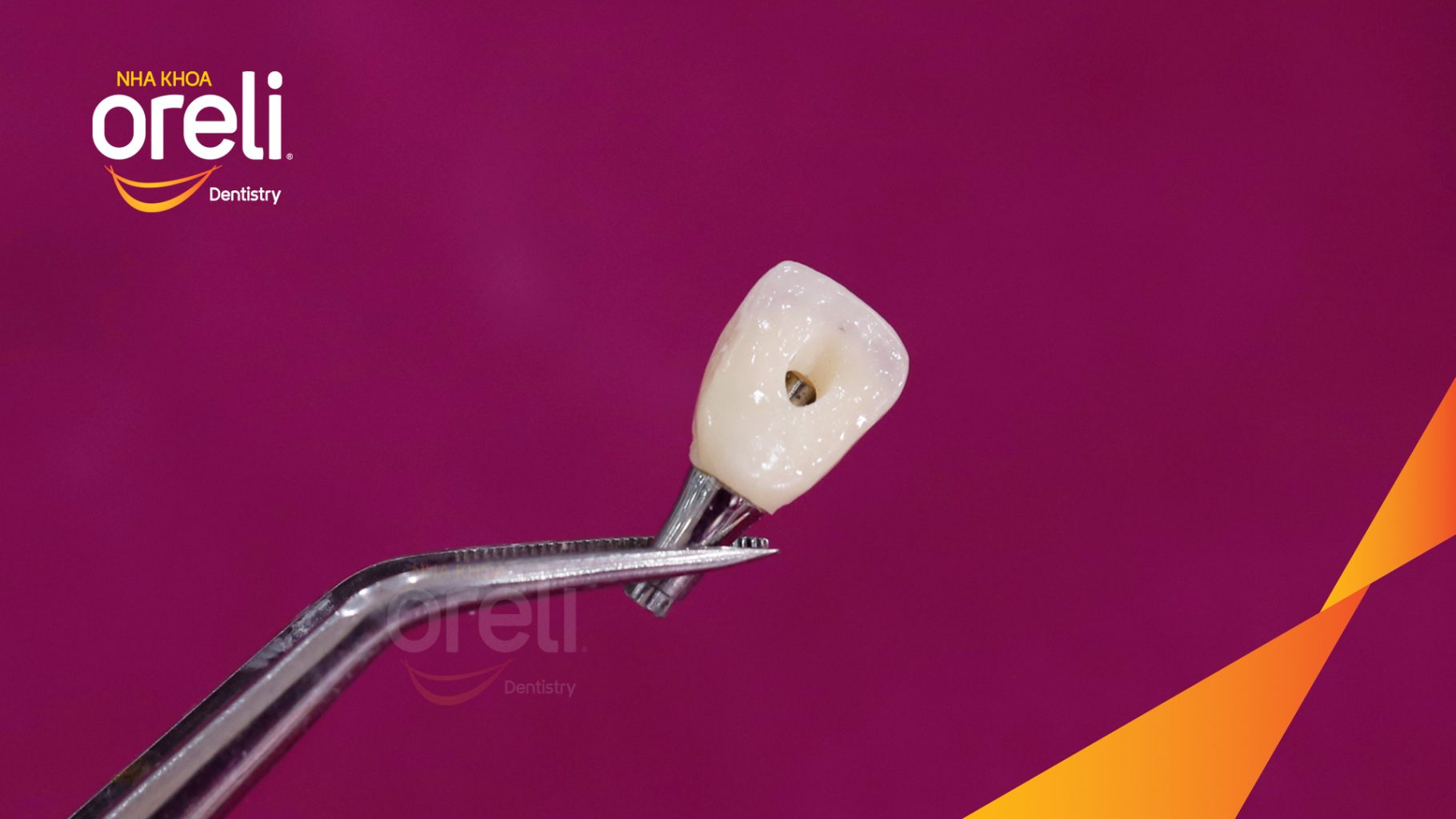 Quá trình Cấy ghép trụ Implant chính hãng vào vùng mất răng trong 3 tháng tại Oreli