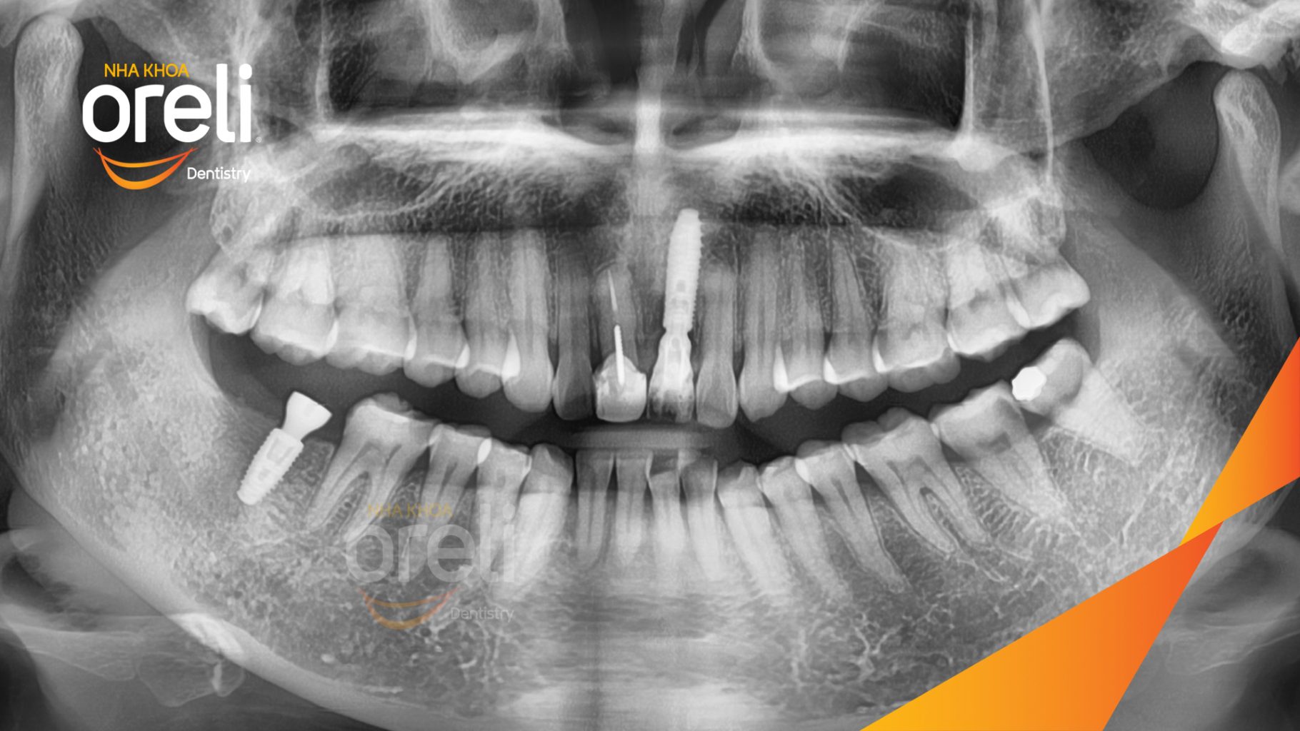 Trước điều trị: Mất răng cửa tại Oreli