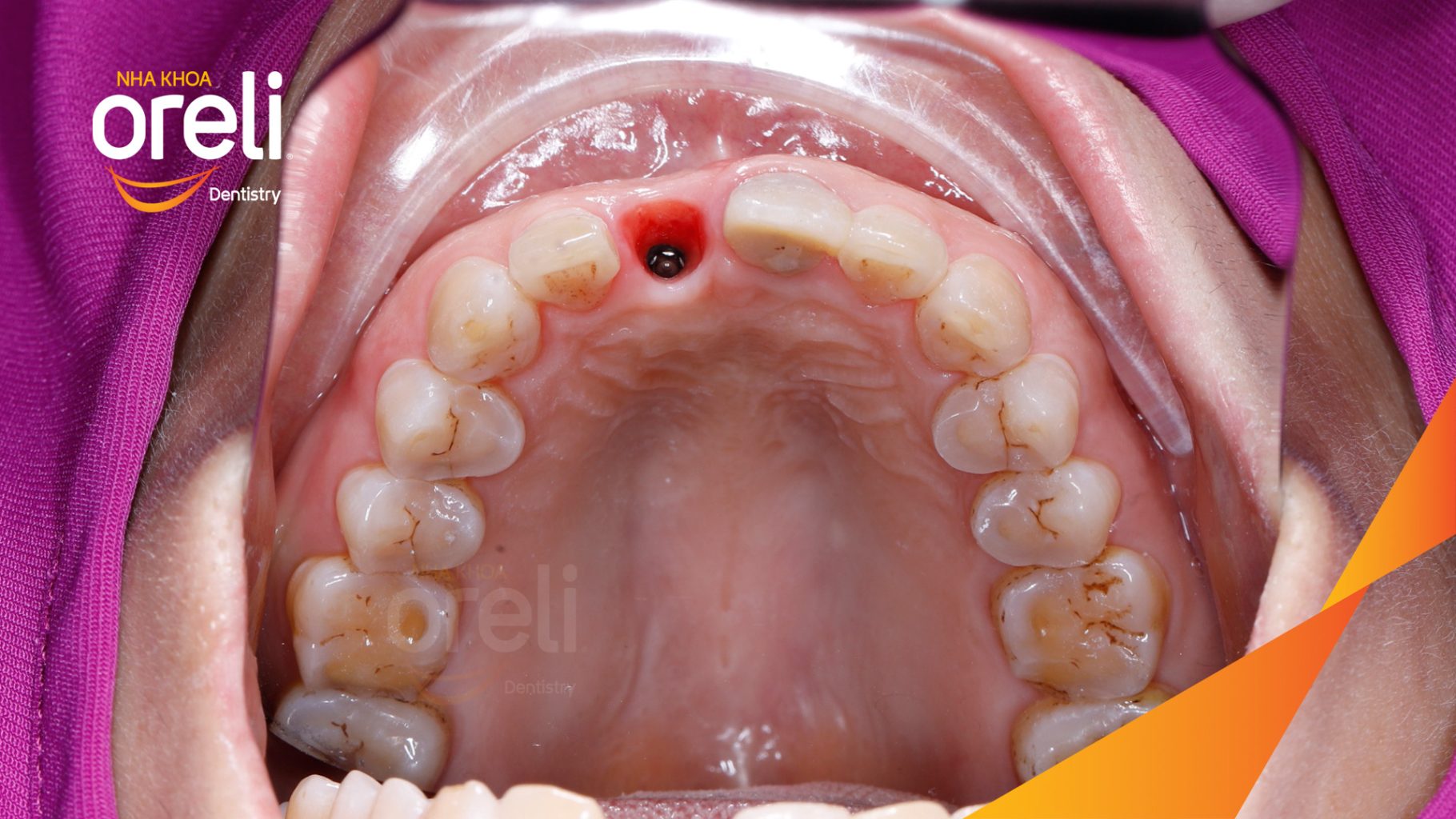 Kết quả sau 3 tháng: Phục hồi răng mất - ăn nhai chắc chắn và cười nói tự tin tại Oreli