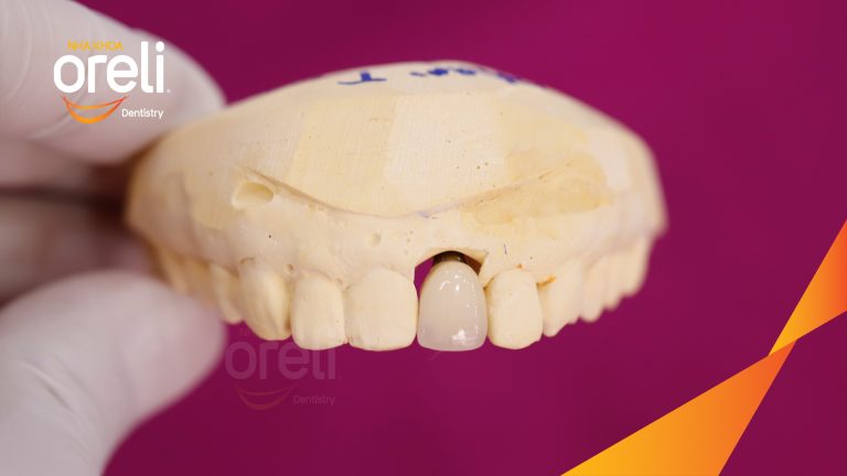 Ca Cấy Ghép Implant Phục Hồi Răng Mất Tại Nha Khoa Oreli