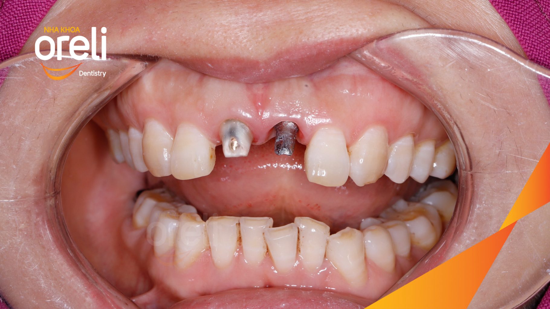 Quá trình Cấy ghép trụ Implant chính hãng vào vùng mất răng trong 3 tháng tại Oreli