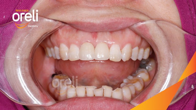 Ca Cấy Ghép Implant Phục Hồi Răng Mất Tại Nha Khoa Oreli
