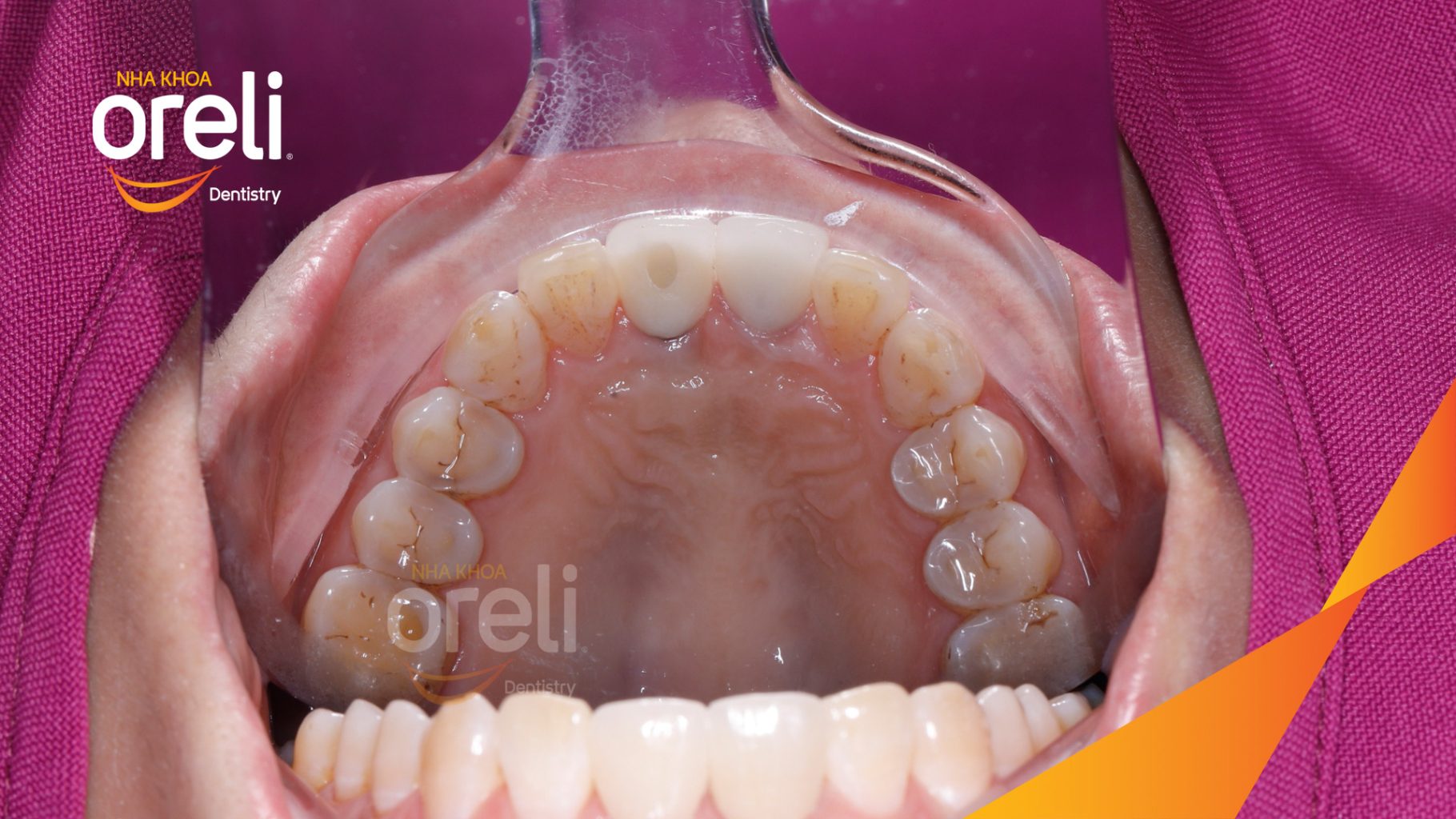 Mất răng cửa trước khi điều trị tại Oreli