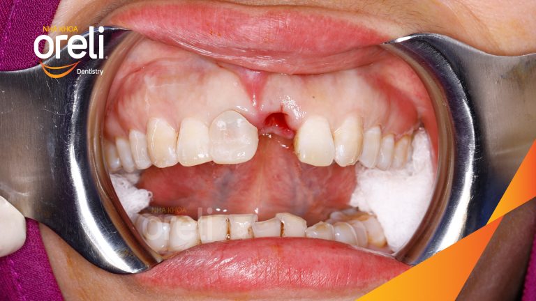 Ca Cấy Ghép Implant Phục Hồi Răng Mất Tại Nha Khoa Oreli