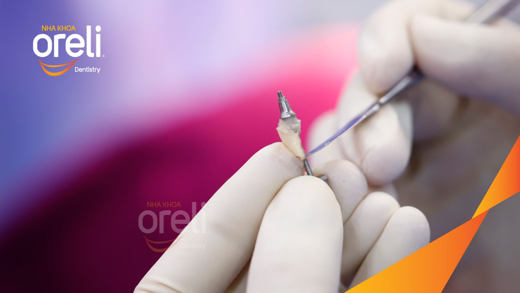 Thực hiện Cấy ghép trụ Implant chính hãng vào vùng mất răng kéo dài 3 tháng tại Oreli