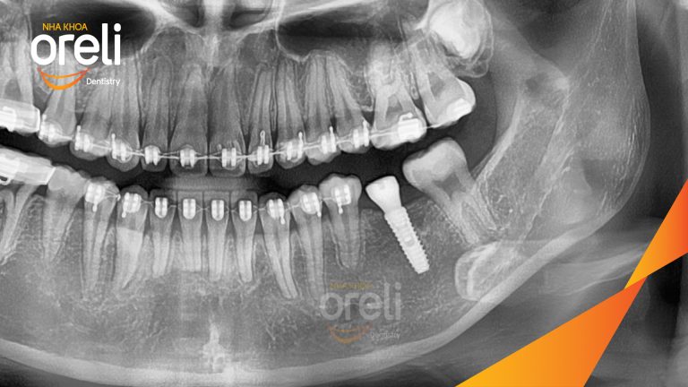 Ca Cấy Ghép Implant Phục Hồi Răng Tại Nha Khoa Oreli