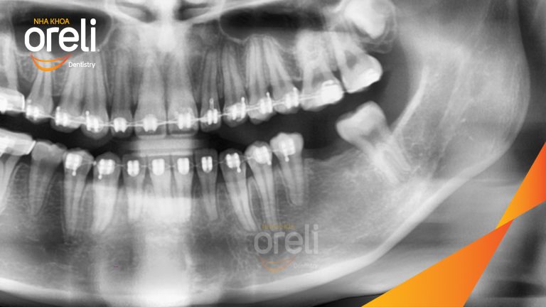 Ca Cấy Ghép Implant Phục Hồi Răng Tại Nha Khoa Oreli