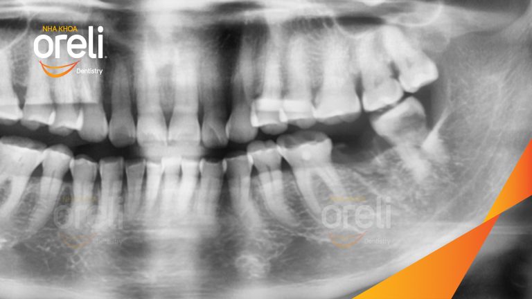 Ca Cấy Ghép Implant Phục Hồi Răng Tại Nha Khoa Oreli