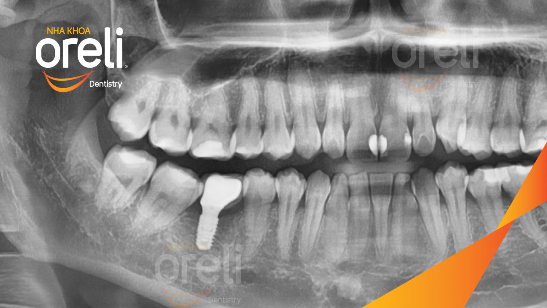 Mất răng hàm dưới trước khi điều trị tại Oreli
