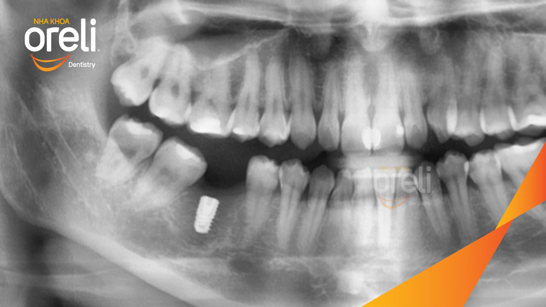 Trước điều trị: Mất răng hàm dưới tại Oreli