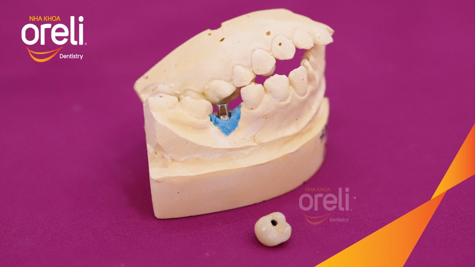 Kết quả sau 3 tháng: Phục hồi răng mất - ăn nhai chắc chắn và cười nói tự tin tại Oreli