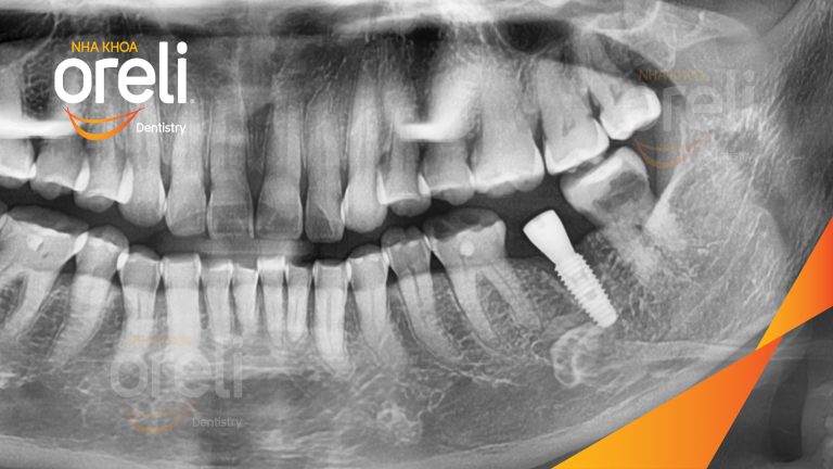 Ca Cấy Ghép Implant Phục Hồi Răng Tại Nha Khoa Oreli