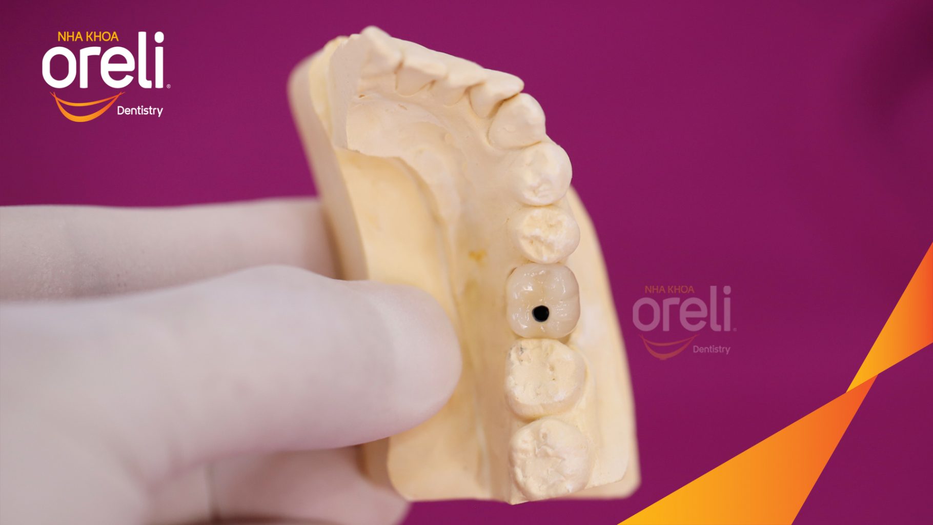 Kết quả đạt được sau 3 tháng - Phục hồi răng mất - ăn nhai chắc chắn và cười nói tự tin tại Oreli