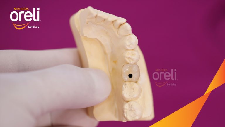 Ca Cấy Ghép Implant Phục Hồi Răng Mất Tại Nha Khoa Oreli