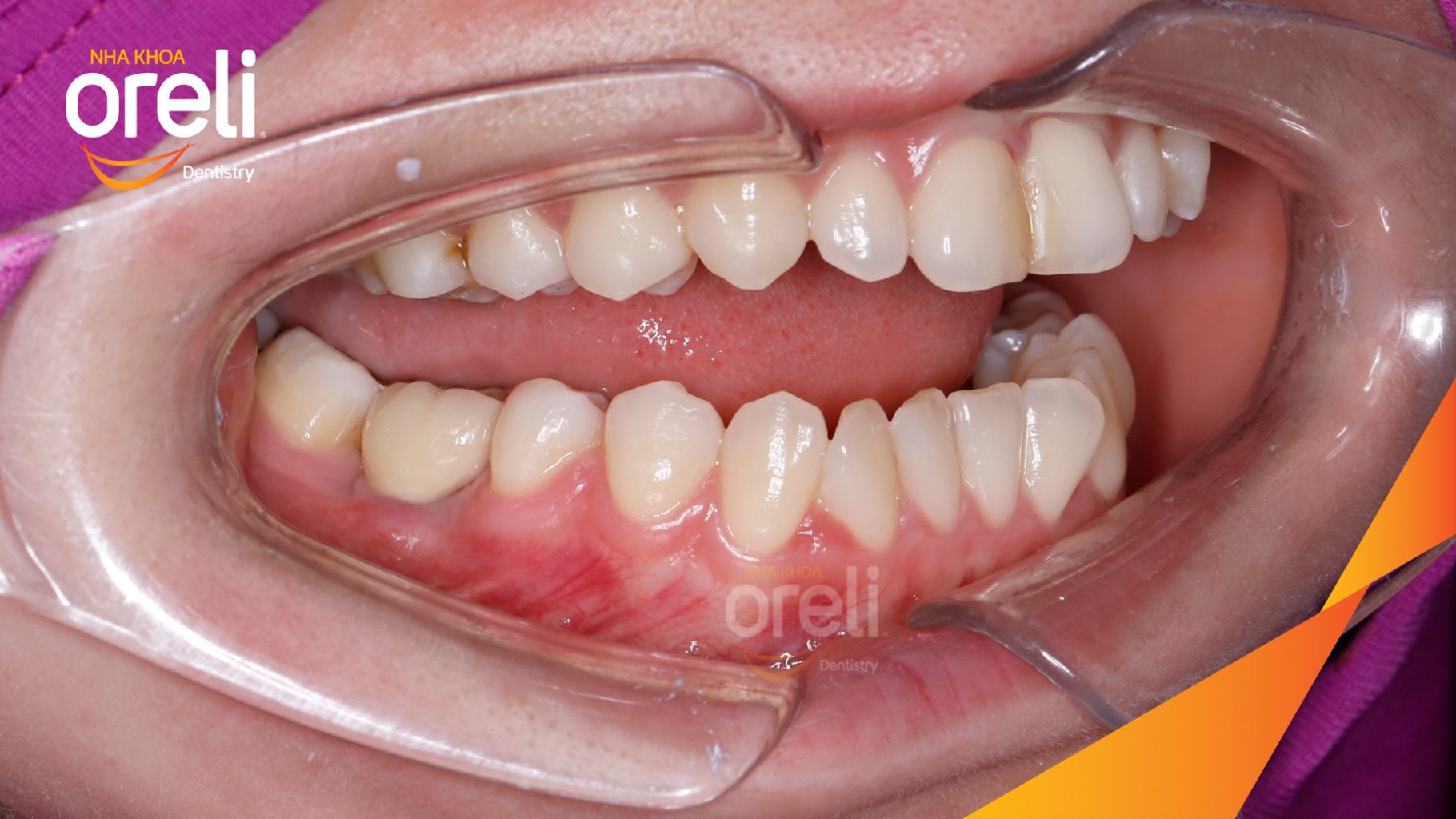 Quá trình Cấy ghép trụ Implant chính hãng vào vùng mất răng trong 3 tháng tại Oreli