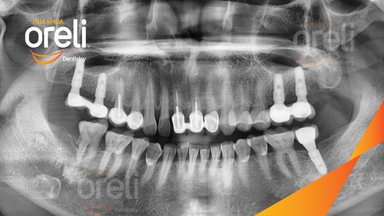Ca Cấy Ghép Implant Hàm Dưới – Case thực tế tại Oreli