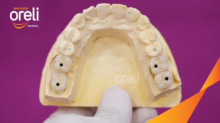 Ca Cấy Ghép Implant Hàm Dưới – Case thực tế tại Oreli
