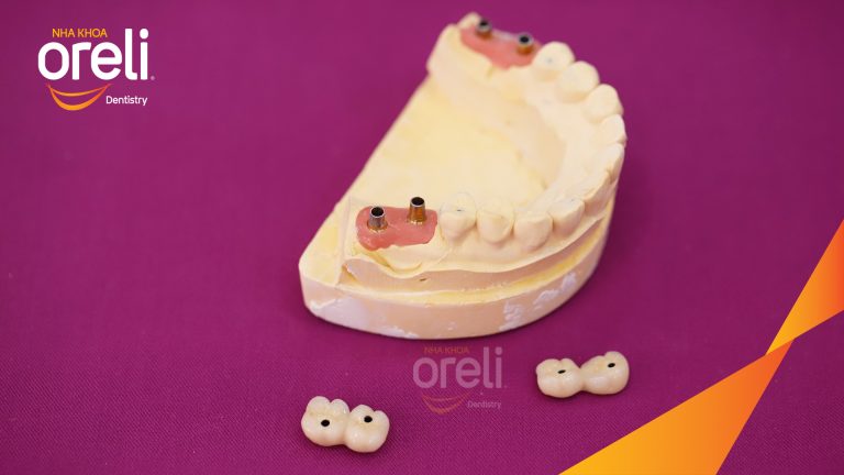 Ca Cấy Ghép Implant Hàm Dưới – Case thực tế tại Oreli