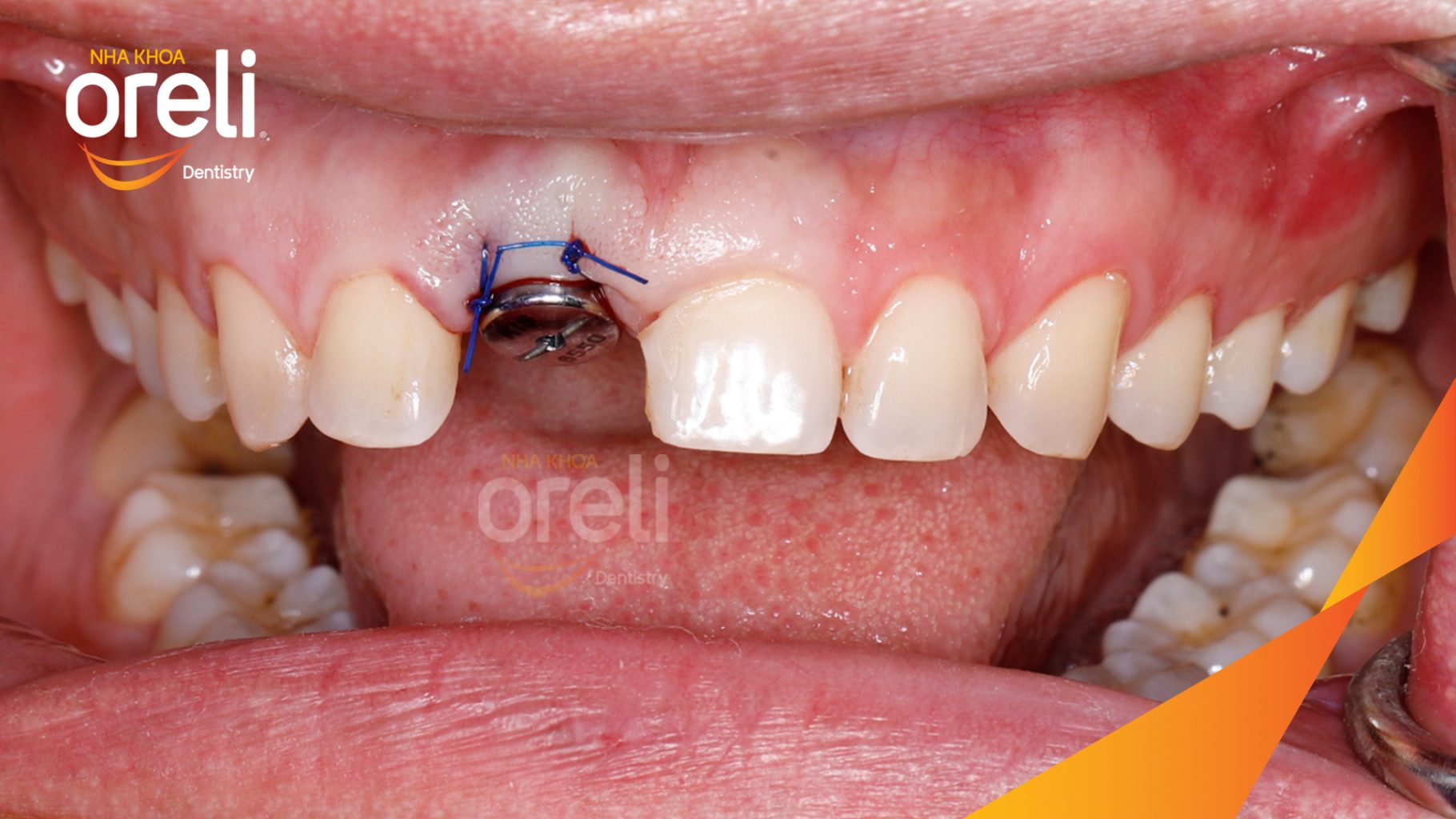 Mất răng cửa  trước khi điều trị tại Oreli