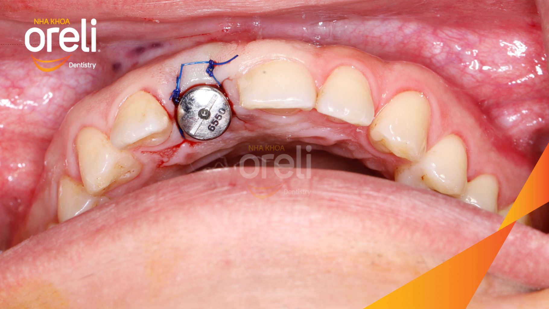 Quá trình Cấy ghép trụ Implant chính hãng vào vùng mất răng trong 3 tháng tại Oreli