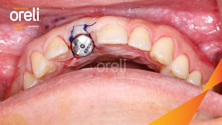 Ca Cấy Ghép Implant Phục Hồi Răng Cửa Tại Oreli