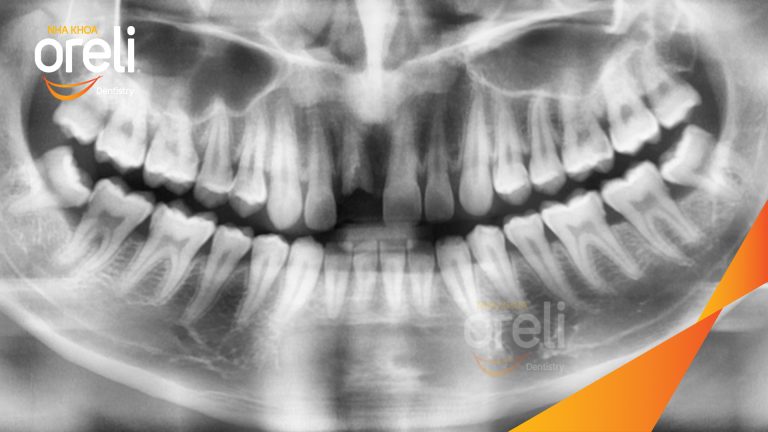 Ca Cấy Ghép Implant Phục Hồi Răng Cửa Tại Oreli