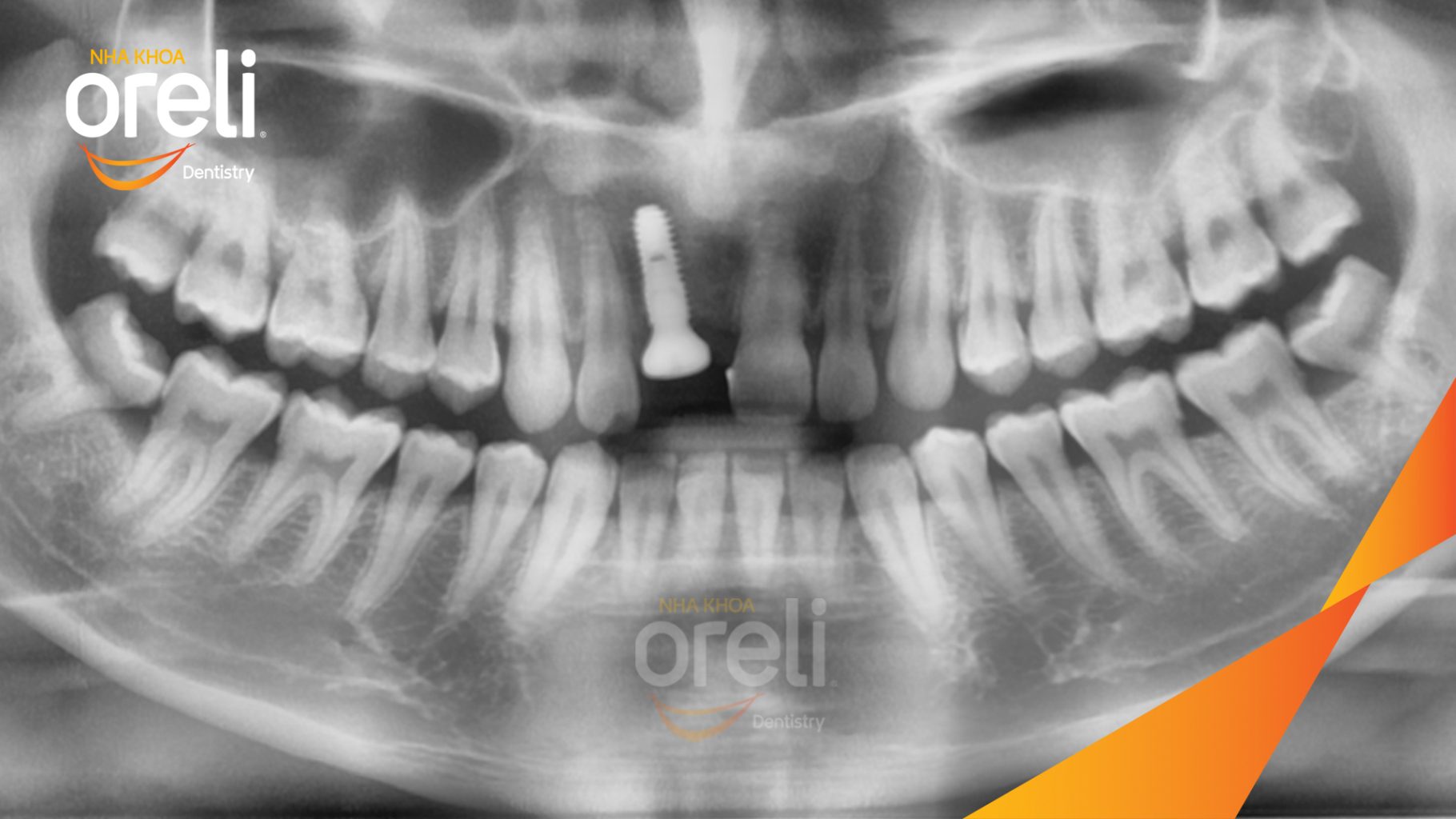 Mất răng cửa  trước khi điều trị tại Oreli