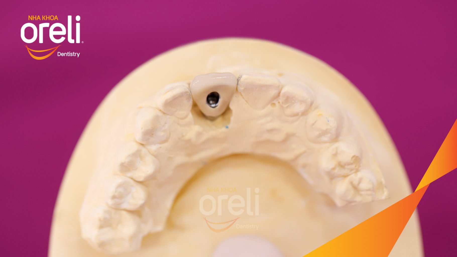 Kết quả sau 3 tháng: Phục hồi răng mất - ăn nhai chắc chắn và cười nói tự tin tại Oreli