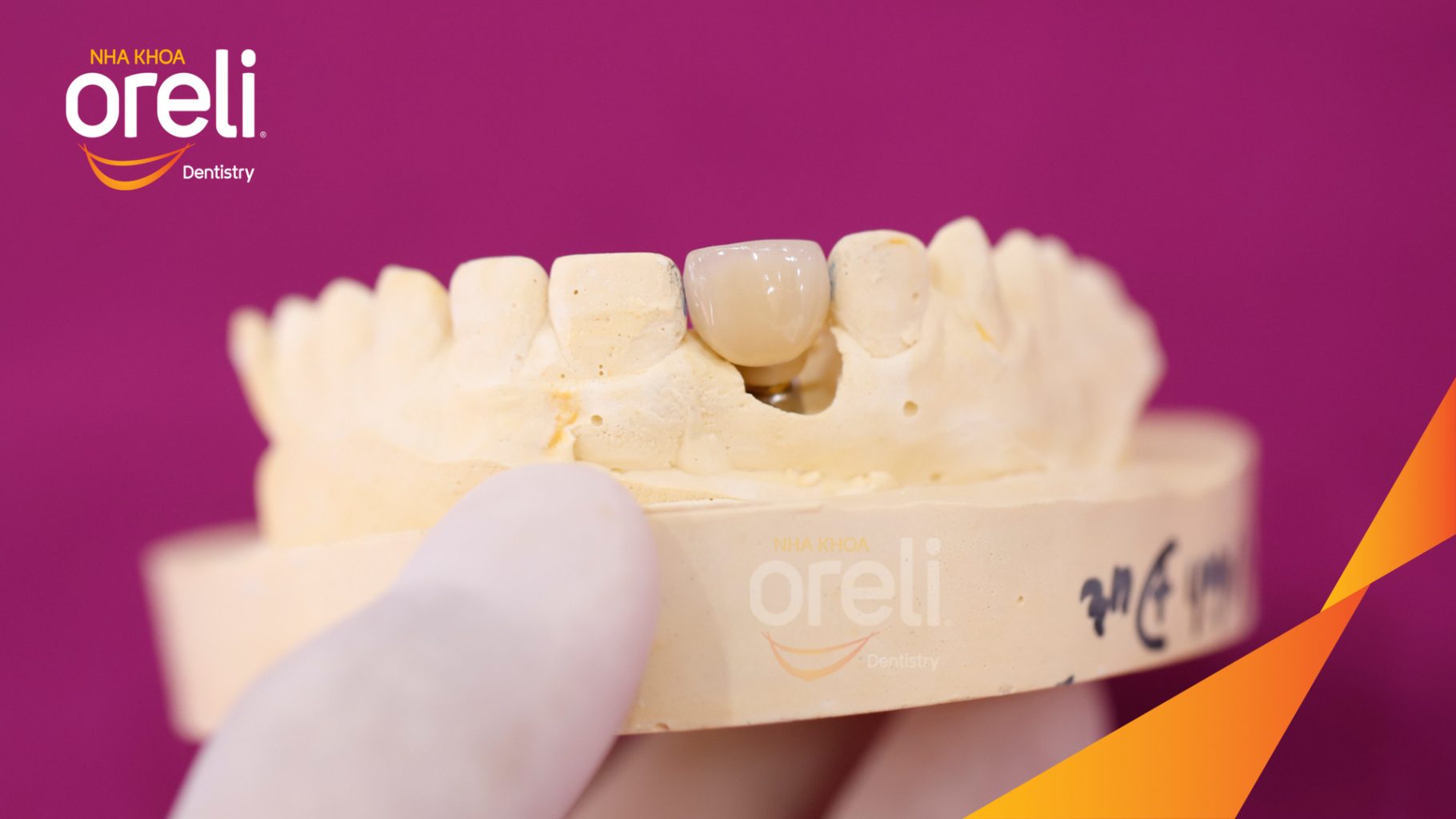 Kết quả đạt được sau 3 tháng - Phục hồi răng mất - ăn nhai chắc chắn và cười nói tự tin tại Oreli