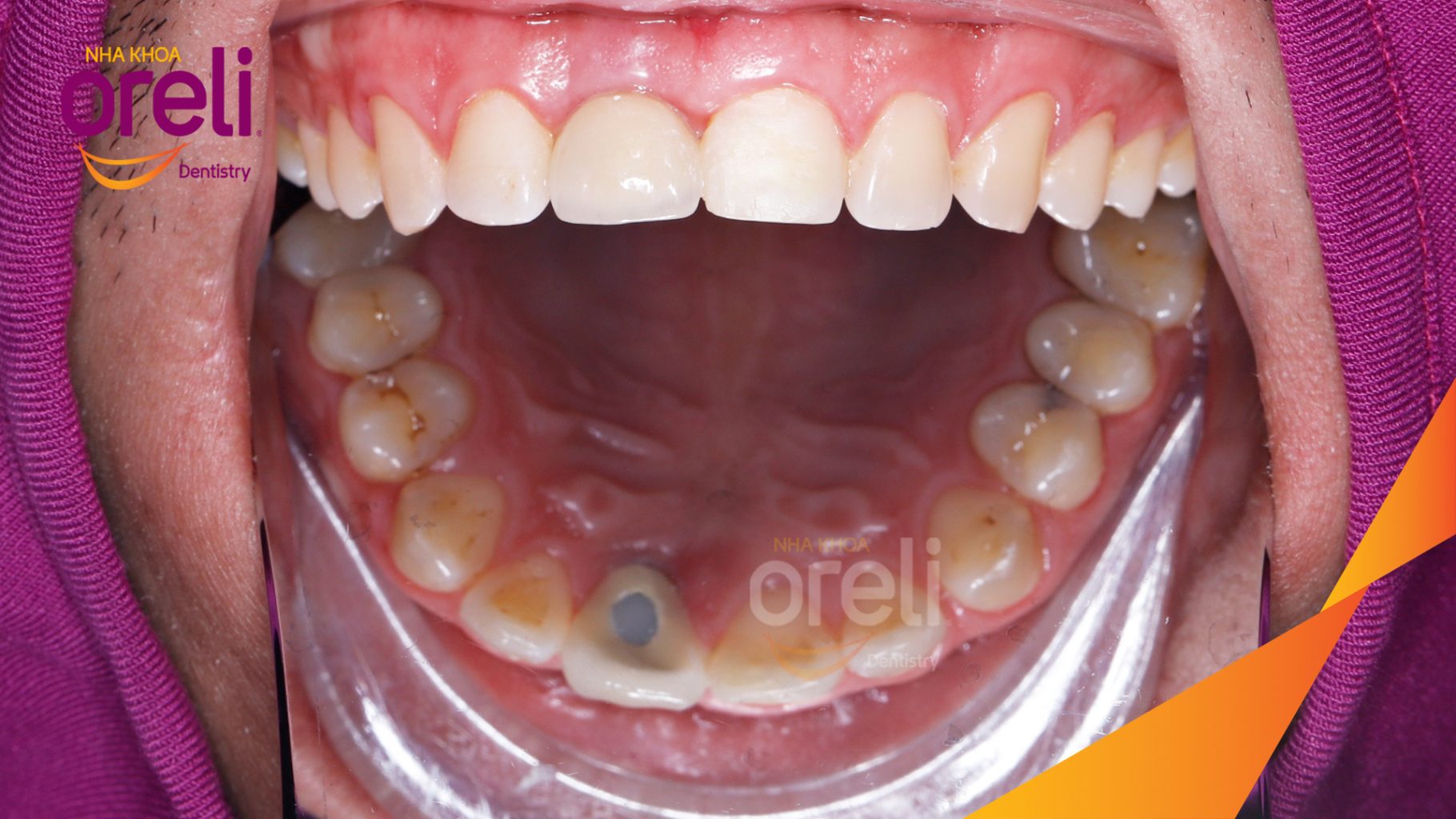 Thực hiện Cấy ghép trụ Implant chính hãng vào vùng mất răng kéo dài 3 tháng tại Oreli