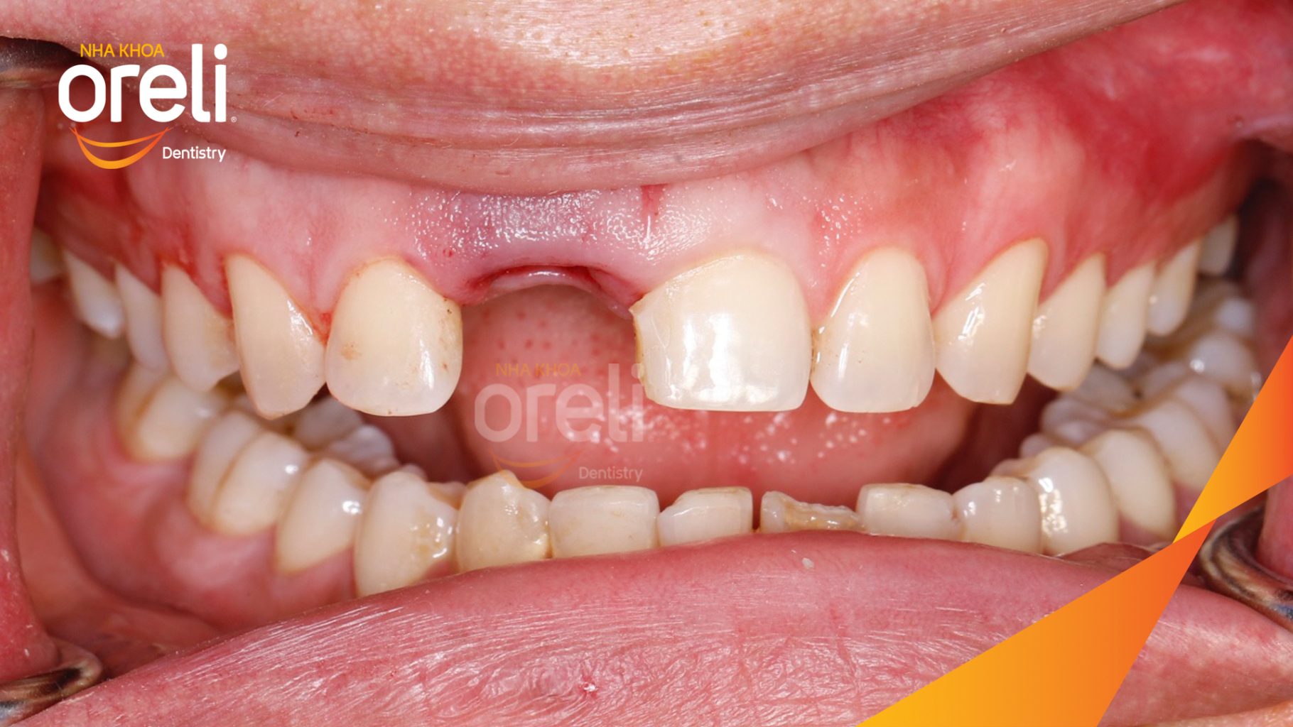 Trước điều trị: Mất răng cửa  tại Oreli