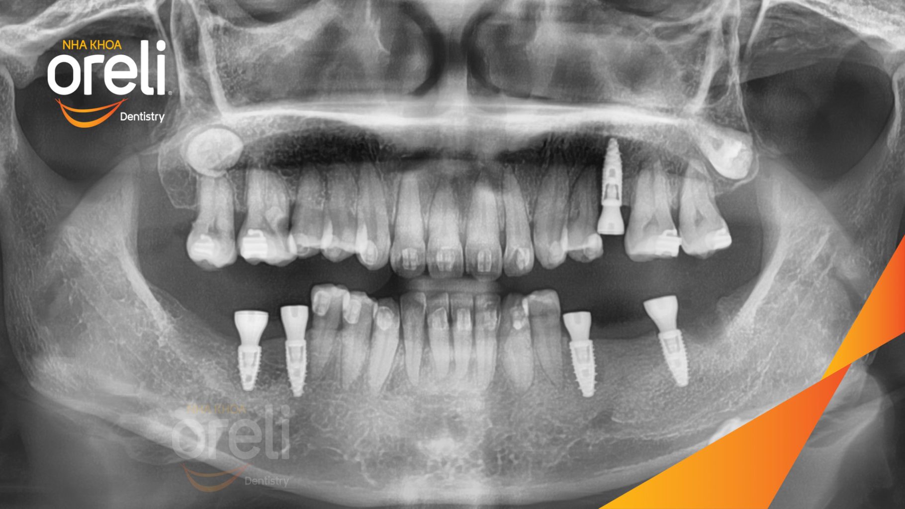 Mất răng hàm trên và dưới trước khi điều trị tại Oreli