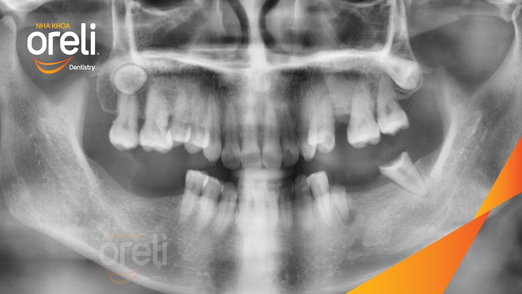 Trước điều trị: Mất răng hàm trên và dưới tại Oreli