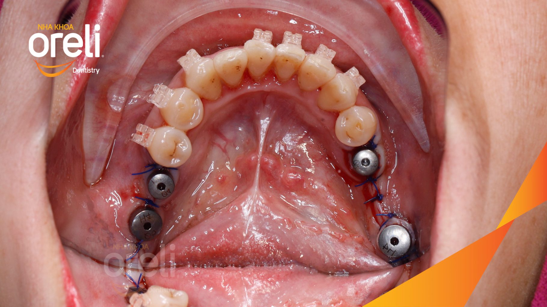 Quá trình Cấy ghép trụ Implant chính hãng vào vùng mất răng trong 3 tháng tại Oreli