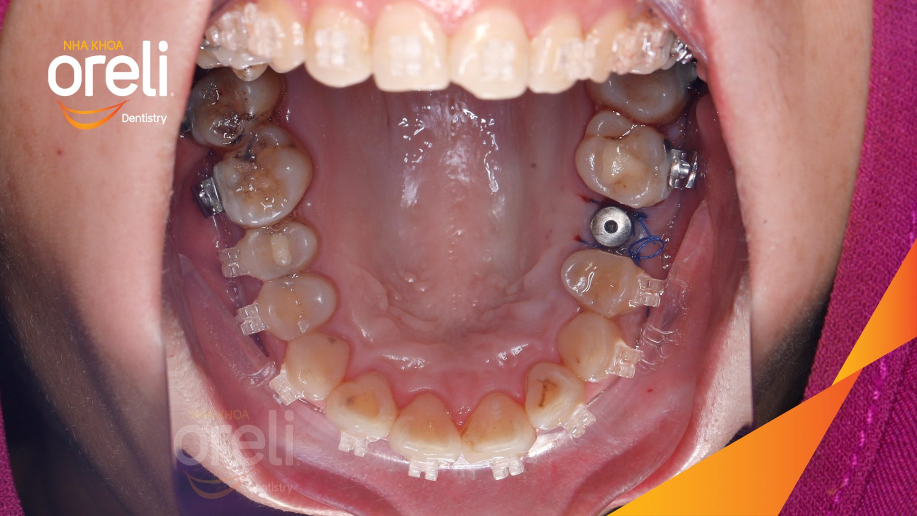Kết quả sau 3 tháng: Hoàn thành đặt trụ Implant đúng vị trí mất răngCa Cấy Ghép Implant Phục Hồi Răng Tại Nha Khoa Oreli tại Oreli