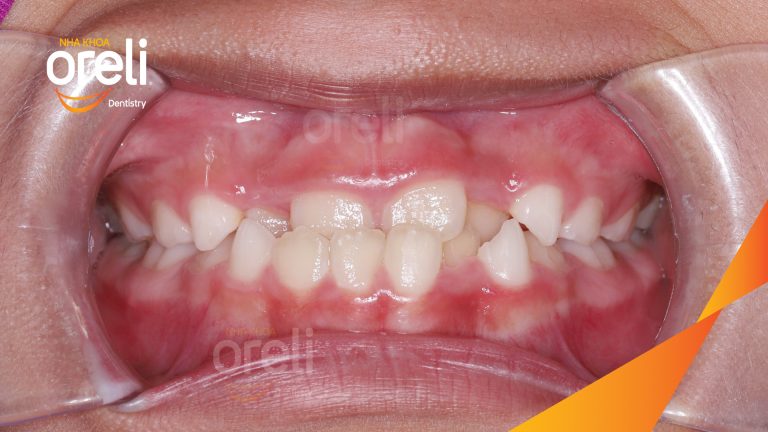 Chỉnh nha sớm ở trẻ em dưới 10 tuổi điều trị móm thành công ở Oreli