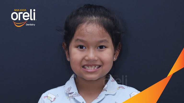 Chỉnh nha sớm ở trẻ em dưới 10 tuổi điều trị móm thành công ở Oreli