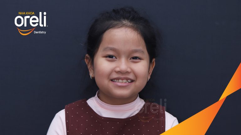 Chỉnh nha sớm ở trẻ em dưới 10 tuổi điều trị móm thành công ở Oreli