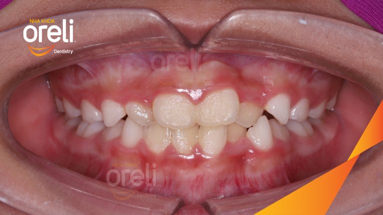 Chỉnh nha sớm ở trẻ em dưới 10 tuổi điều trị móm thành công ở Oreli