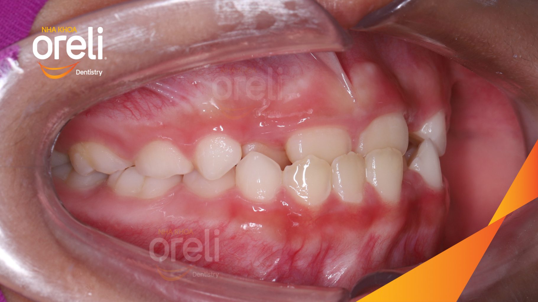 Kết quả sau 6 tháng: Khớp cắn đúng hết móm tại Nha khoa Oreli