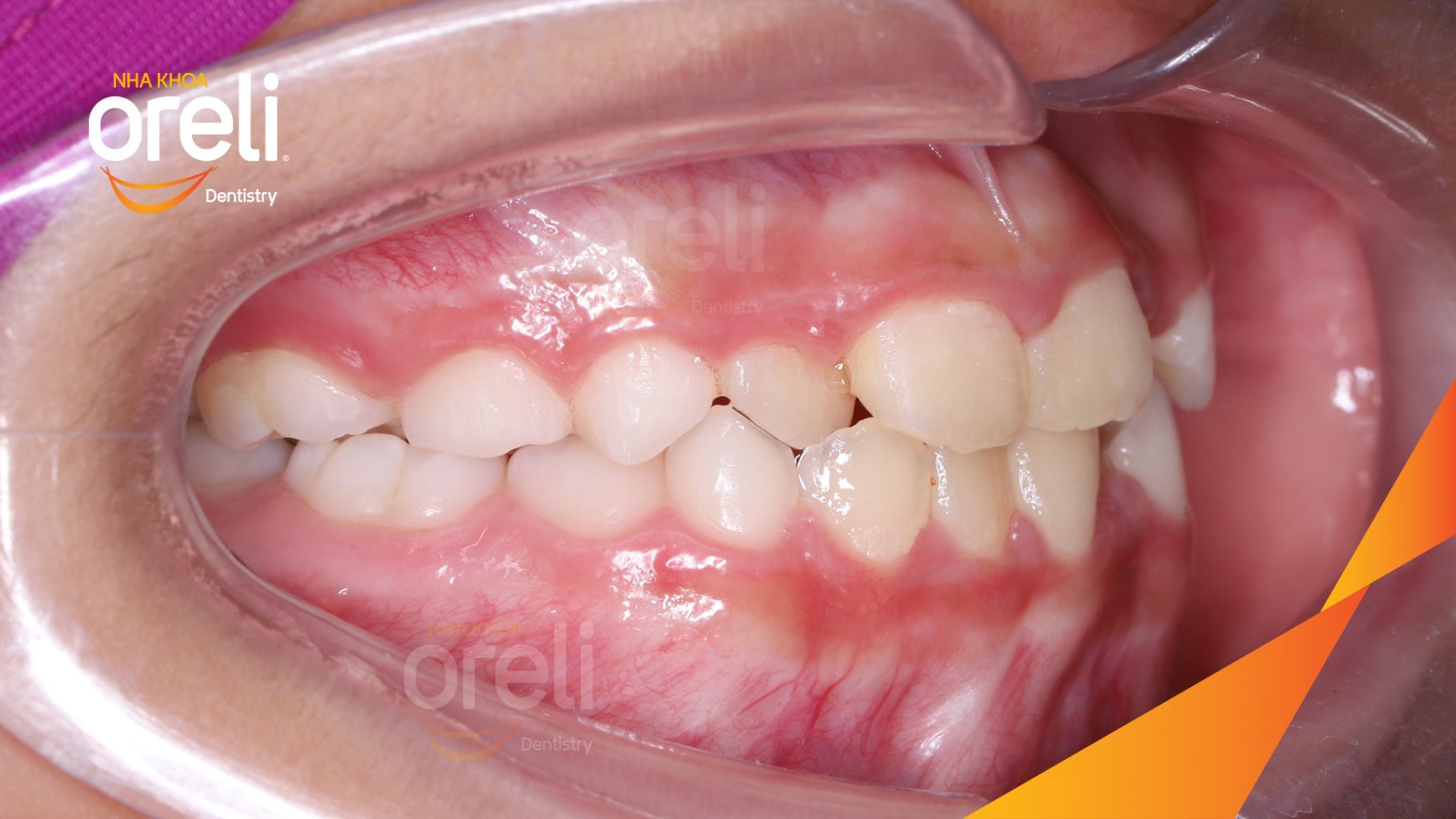 Kết quả đạt được sau 6 tháng - Khớp cắn đúng hết móm tại Nha khoa Oreli